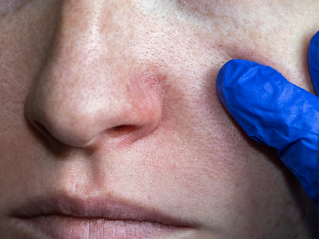 Cuperoza: Cauze, simptome și tratamente eficiente pentru o piele sănătoasă