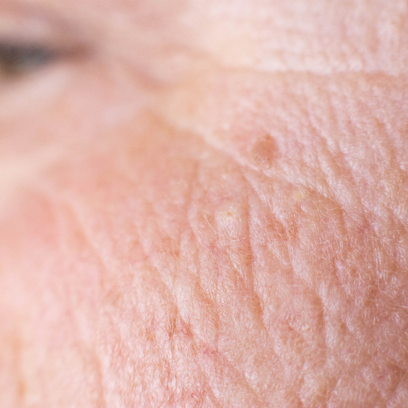 Rolul Epidermei în Combaterea Îmbătrânirii Dincolo de Suprafață Rolul Epidermei în Combaterea Îmbătrânirii: Dincolo de Suprafață